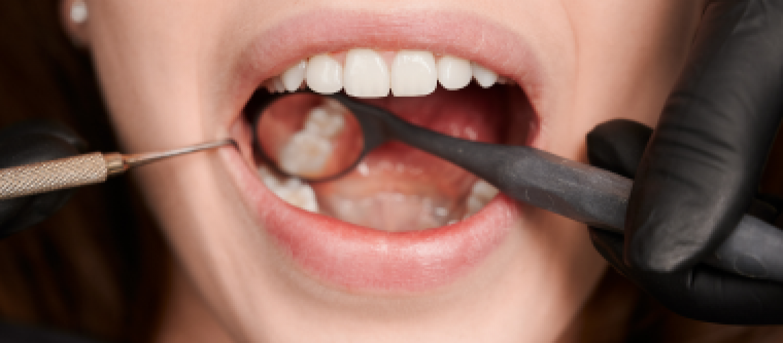 Tooth-Cavity