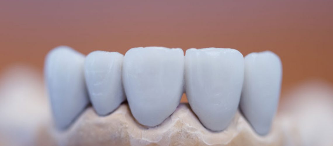a monolithic dental bridge model.